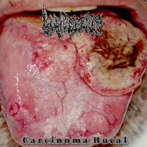 Lymphangiomas : Carcinoma Bucal Lymphangiomas : Carcinoma Bucal